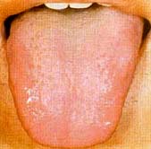 سفید شدن زبان , رنگ زبان , خشکی زبان نشانه چیست 