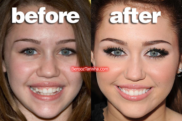 teeth miley چهره باورنکردنی این ستاره ها قبل و بعد از مشهور شدن