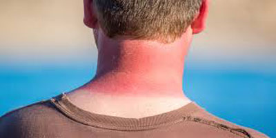 آفتاب سوختگی , راه‌هاي درمان آفتاب‌سوختگي