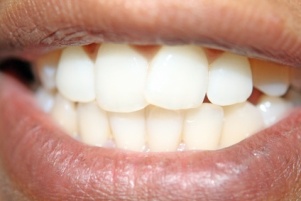 راه تشخیص پوسیدگی دندان , تشخیص پوسیدگی دندان از روی عکس رادیولوژی , تصاویر پوسیدگی دندان 