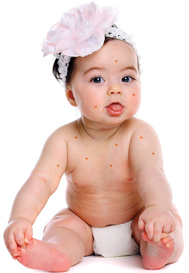 دانه های قرمز روی پوست کودکان , جوش های ریز روی بدن کودک , جوش زدن بدن نوزاد 