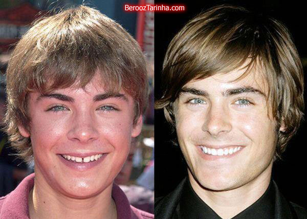 teeth 60 چهره باورنکردنی این ستاره ها قبل و بعد از مشهور شدن
