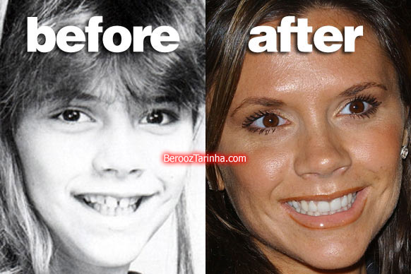 teeth posh چهره باورنکردنی این ستاره ها قبل و بعد از مشهور شدن
