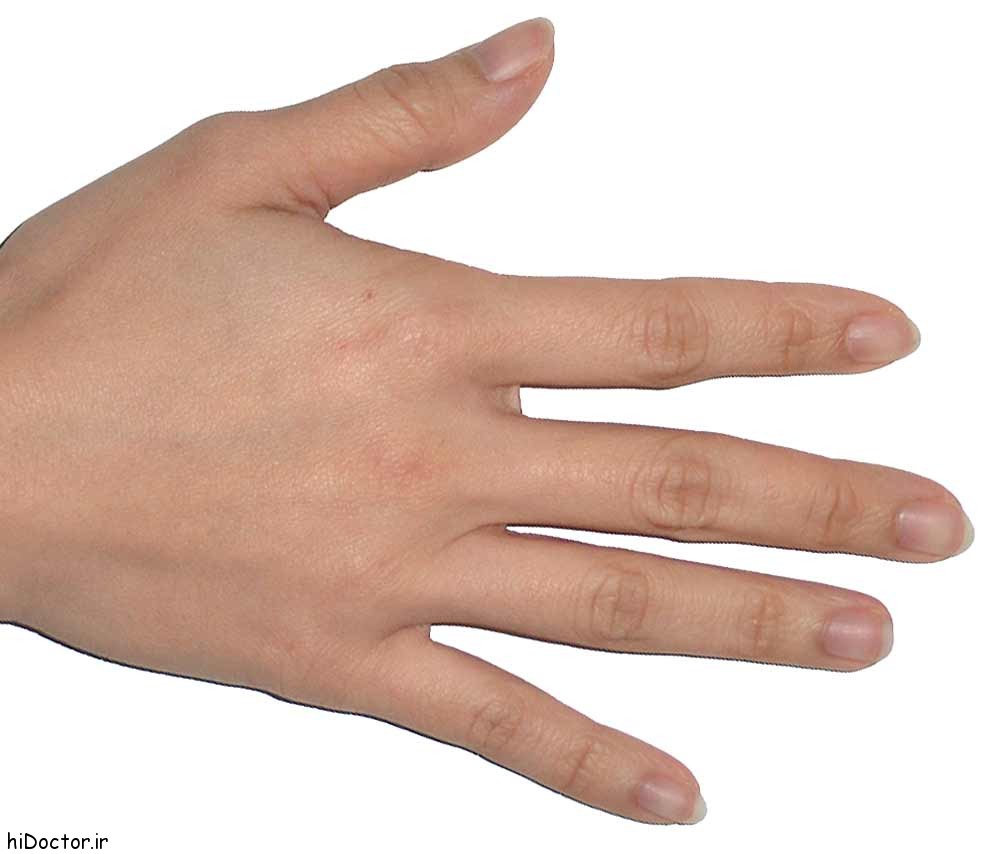 دست , درمان خانگی پوسته شدن دستها , پوسته پوسته شدن پوست دست 