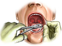 dental_extraction_drawing.jpg