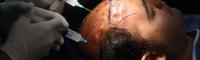 گزارش تصویری جالب از کاشت مو - کاشت مو برزو ارجمند