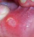 آفت دهان چیست؟ -علل ، درمان ( مرجع کامل اطلاعات )