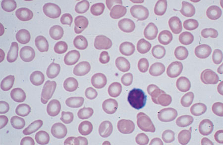 هیپرکرومازیا و میکروسیتیک زیاد . کم خونی اهن . لنفوسیت کوچک در میدان