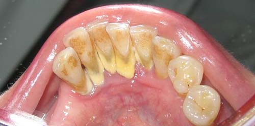 واریس دهان , آفت و لکه های دهانی , علت زخم دهان و زبان 