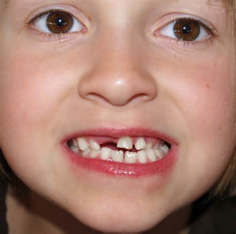 دندان شیری چیست؟ , تاخیر در زمان افتادن دندان شیری , سن ریختن دندانهای شیری 