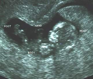 Pregnancy Ultrasound Picture : week 11