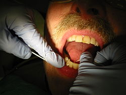 یک بهداشتکار دهان و دندان در حال نخ کشیدن دندان بیمار