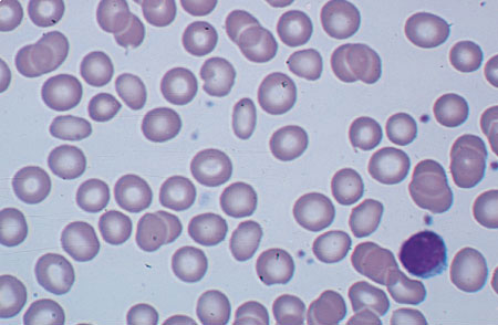 هایپرکروموزیا و میکروسیتیک کم . کم خونی اولیه آهن . لنفوسیت کوچک در گوشه راست میدان