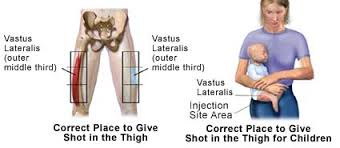 تزریق داخل عضلانی در کودکان   Vastus lateralis muscle - ventrogluteal muscle