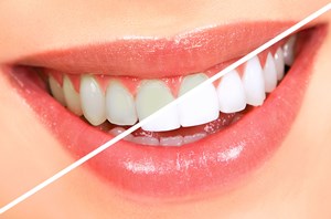 جرم گیری، بروساژ و سفید کردن دندان چه تفاوتی دارند؟