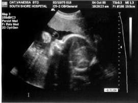 Pregnancy Ultrasound Picture : week 32