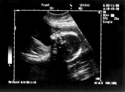Pregnancy Ultrasound Picture : week 21