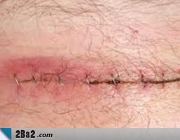 Surgical-wound-infection.jpg