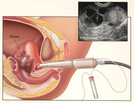 بارداری به روش IVF + بارداری به روش میکرو انجکشن ICSI
