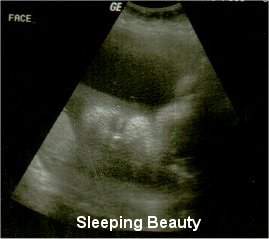 Pregnancy Ultrasound Picture : week 33