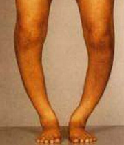 پاهای پرانتزی در کودکان --- نرمی استخوان یا راشی تیسم