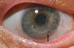 التهاب چشم چیست , درمان ادم قرنیه , ادم قرنیه چیست 