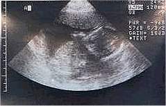 Pregnancy Ultrasound Picture : week 19