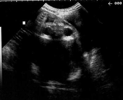 Pregnancy Ultrasound Picture : week 34