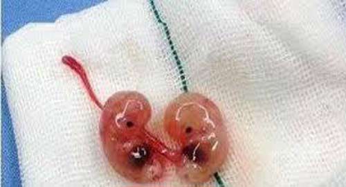 عکس جنین سقط شده در شش هفتگی 