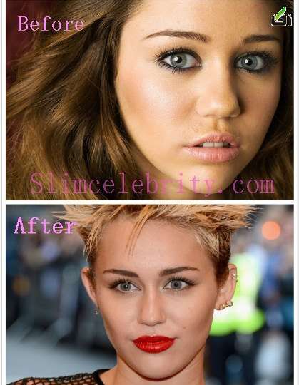 عکس: مایلی سایرس قبل و بعد از عمل زیبایی! آیا او زیباتر شده؟! -آکا