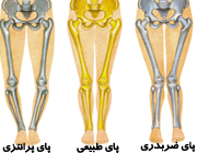 چگونه پلاتین در ساق پا میشکند 