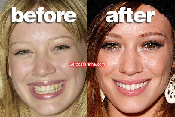 teeth hilary چهره باورنکردنی این ستاره ها قبل و بعد از مشهور شدن