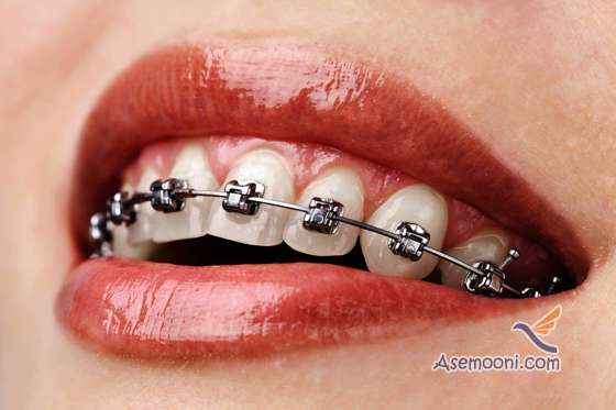 types of orthodontic procedures2 انواع روش های ارتودنسی