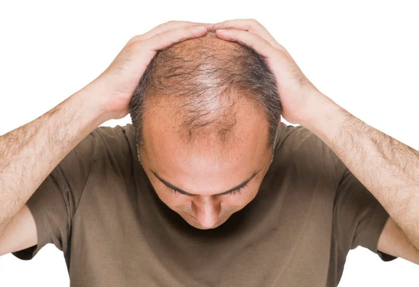 درمان ریزش موورشدمجدد , بهترین راه برای درمان ریزش موی ارثی , آیا ریزش ارثی مو درمان دارد؟ 