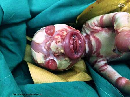 تولد نوزادی‌ با‌‌ بیماری‌ وحشتناک‌ در داراب
