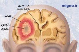 عود تومور مغزی در زمان بارداری , تومور مغزی غذا , تومور مغزی بدخیم چقدر زنده میمونه 