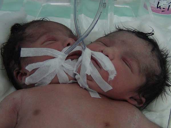تولد نوزاد دو سر در بیمارستان گنجویان دزفول+عکس