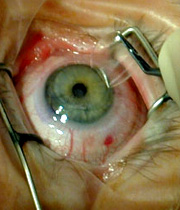 جراحی لیزیک چشم