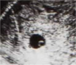Pregnancy Ultrasound Picture : week 5