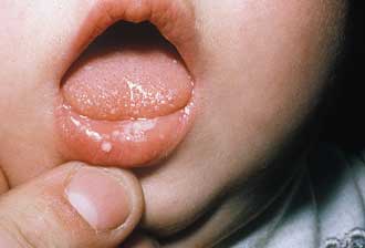 برفک دهان نوزاد , برفک دهان کودکان همراه با تب , درمان برفک دهان نوزاد 