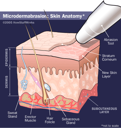 زیبایی، شفافیت و جوان سازی پوست توسط دستگاه میکرودرم ابریشنmicrodermabrasion
