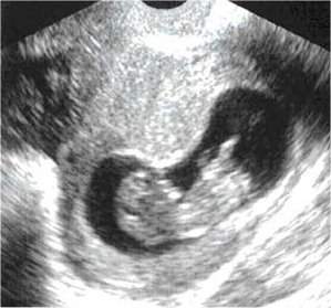 Pregnancy Ultrasound Picture : week 10