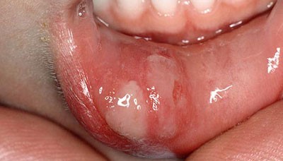 درمان زخم افتادن زبان , زخم زبان در کودکان با عکس , بیماریهای دهان 
