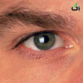 تقویت ضعف چشم ها در طب سنتی , درمان ضعیف شدن چشم با رازیانه , ضعف عصب بینایی کودکان 