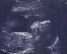 Pregnancy Ultrasound Picture : week 23