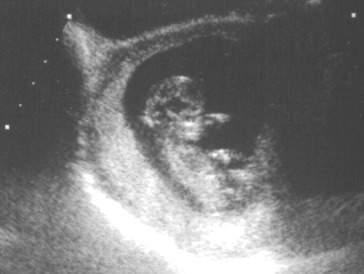 Pregnancy Ultrasound Picture : week 12