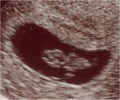 Pregnancy Ultrasound Picture : week 8