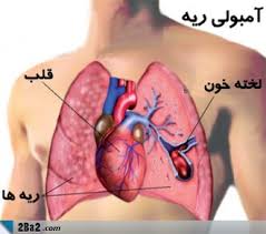 آمبولی چیست , امبولی ریه چیست؟ , علایم خطرناک در درد قفسه سینه برای کسب که آمبولی دارد چیست؟ 