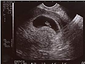 Pregnancy Ultrasound Picture : week 7