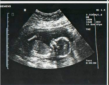Pregnancy Ultrasound Picture : week 17